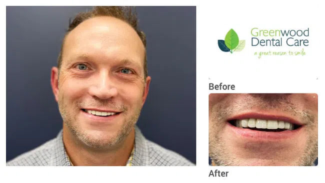 Smiling man showing dental improvement with before and after teeth photos, Greenwood Dental Care logo visible.