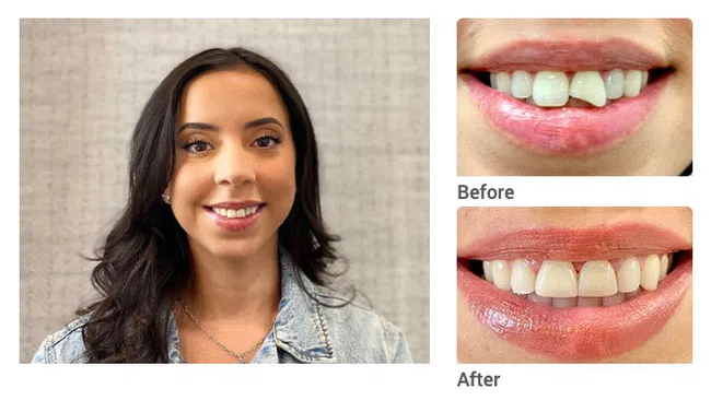 Smiling woman with healthy teeth next to before and after close-up of dental correction on front tooth.