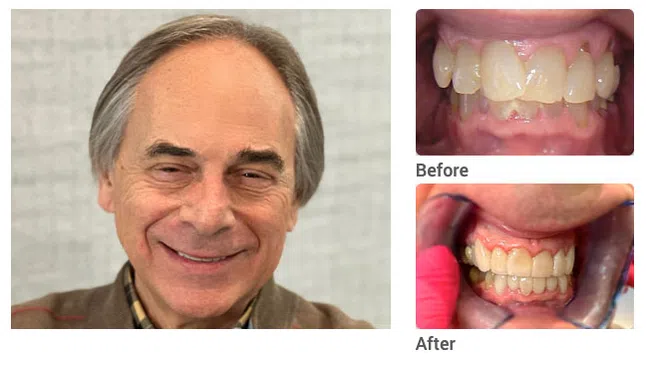 Smiling older man with before and after close-ups of dental implants restoring his teeth.