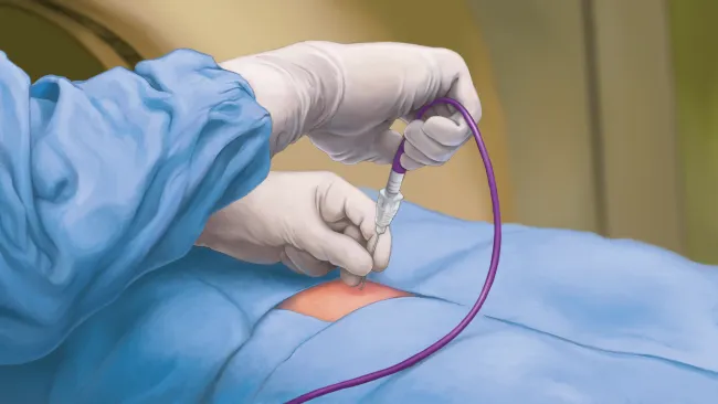 Doctor wearing gloves performing a catheter insertion through a patient's skin during a medical procedure.