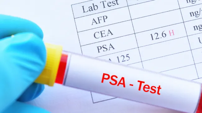 Gloved hand holding a blood sample tube labeled PSA test over a lab test results sheet showing PSA results.