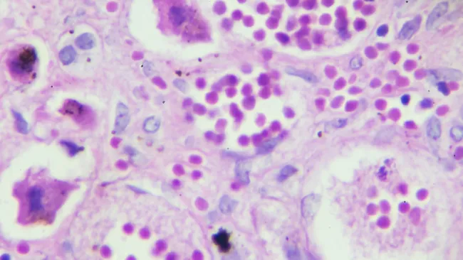 Microscopic view of clustered purple cells stained on a light pink tissue background under a microscope.