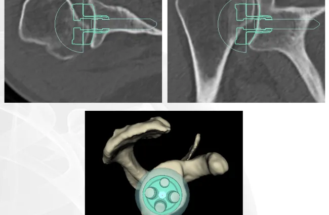 CT scans and 3D model showing a shoulder implant positioning with surgical guides and bone structure.