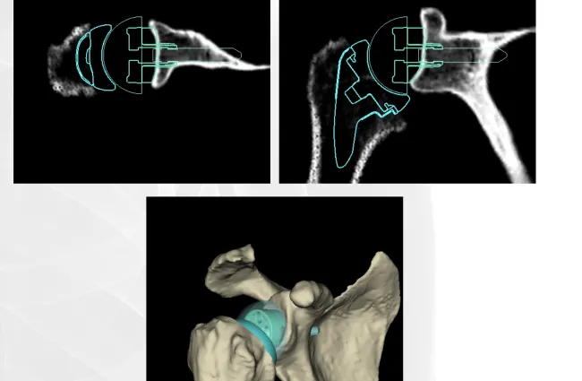 CT scan and 3D model of shoulder joint with overlays indicating implant positioning and anatomy.