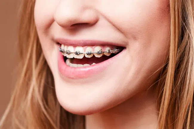Got Braces? Here’s What You Can Eat