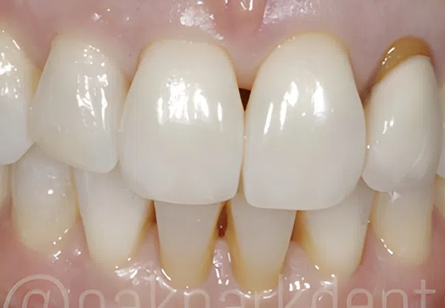 Close-up of human teeth showing natural color variation and slight plaque build-up on lower teeth.