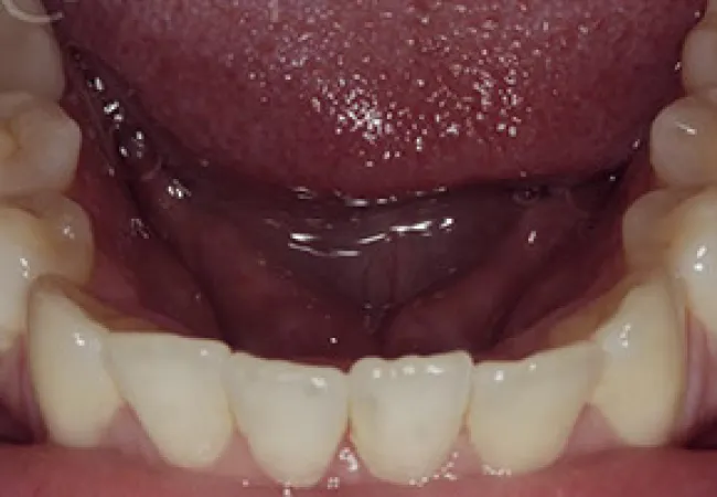 Close-up of lower teeth and tongue inside an open mouth showing natural dental alignment and gums.