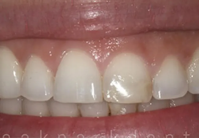 Close-up of a smile showing upper front teeth with one tooth visibly discolored compared to others.