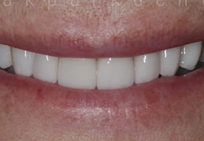 Close-up of a bright white smile showing healthy, evenly aligned teeth and natural lips.