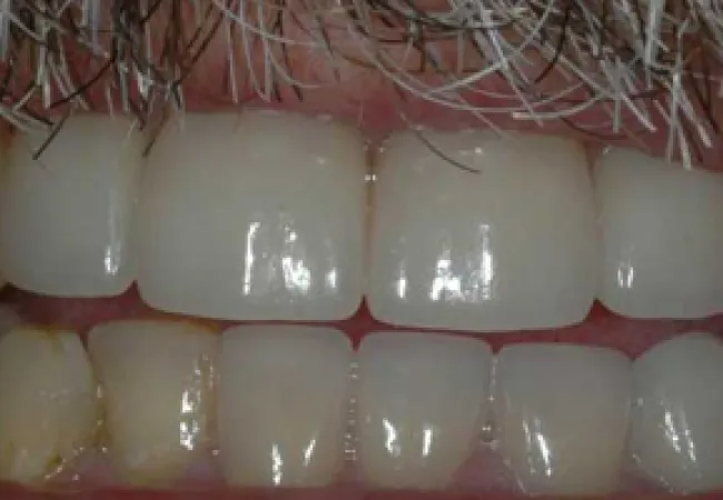 Close-up of upper and lower teeth showing dental issues including discoloration and plaque buildup.