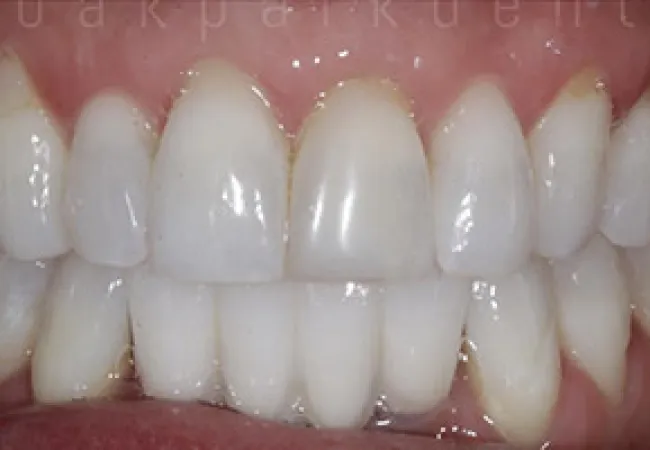 Close-up of clean, white, well-aligned upper and lower human teeth and gums.
