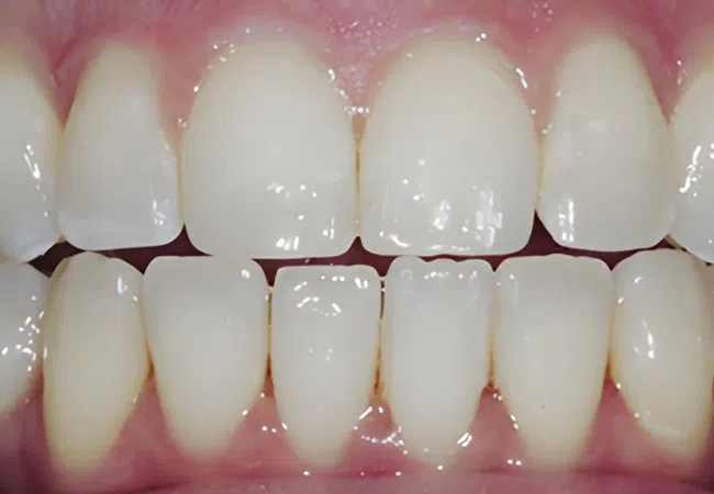 Close-up of healthy upper and lower natural teeth with pink gums and no visible dental issues.