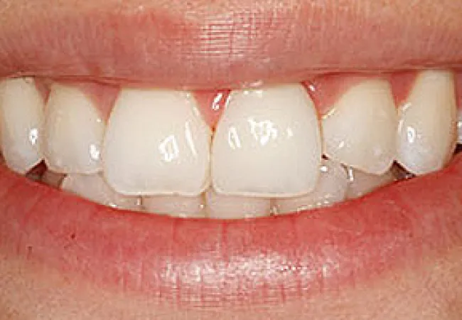Close-up of a smiling mouth showing slightly spaced, clean, and healthy white teeth with natural gums.