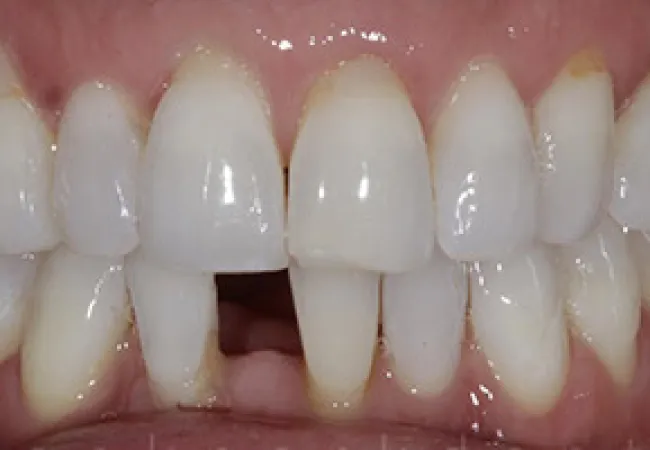 Close-up of upper and lower teeth showing a missing front lower tooth with healthy gums.