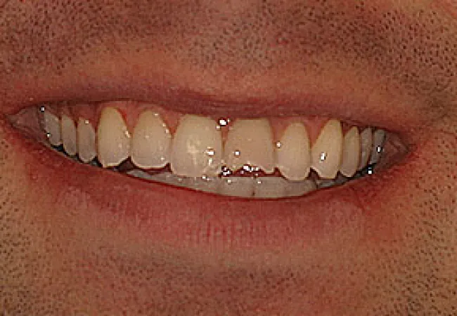 Close-up of a smiling mouth showing slightly uneven teeth and light facial hair stubble.