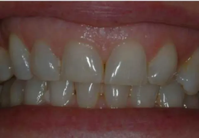 Close-up of a smiling mouth showing slightly misaligned upper and lower teeth with minor discoloration.