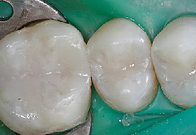 Close-up of three polished molar teeth with dental clamp and green rubber dam isolation in dental treatment.
