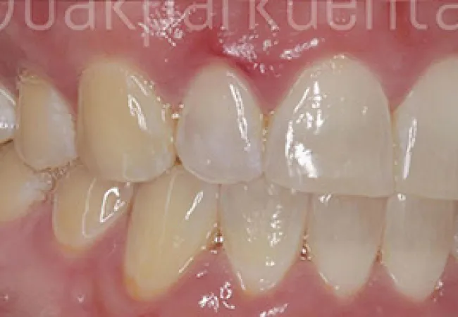 Close-up of human teeth showing natural color variation and gum health in a detailed dental image.