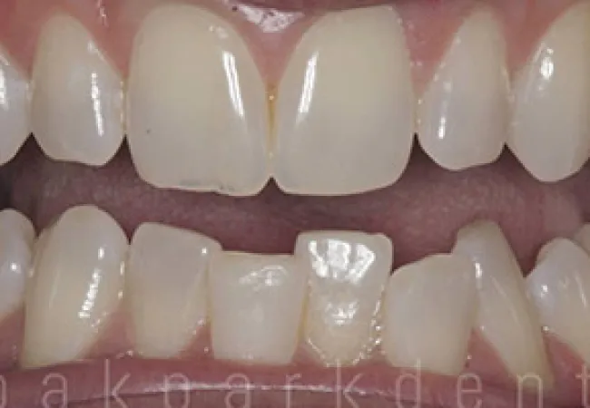 Close-up of an open mouth showing upper and lower teeth with gaps and irregular alignment.