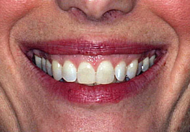 Close-up of a smiling woman's mouth showing natural teeth with light pink lips and skin texture.