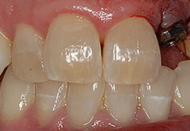 Close-up of natural teeth showing mild yellow staining and uneven alignment with healthy pink gums