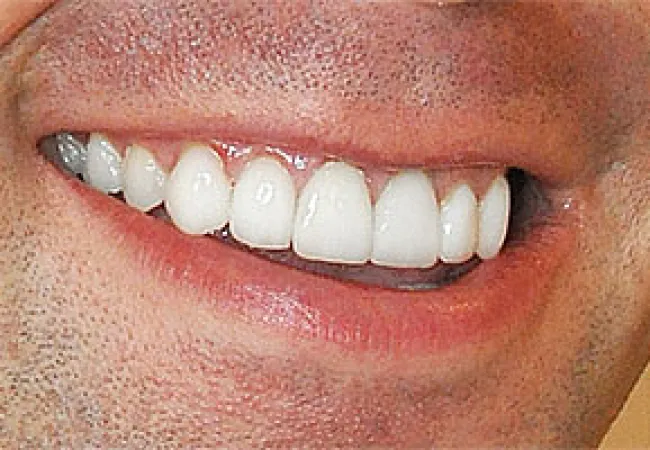 Close-up of a smiling person showing clean, white teeth and part of their lips and skin texture.