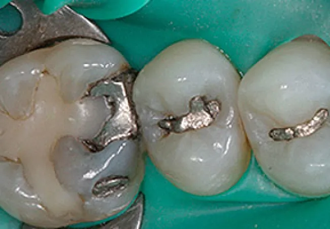 Close-up of molar teeth with old silver dental fillings and dental dam in place during treatment.