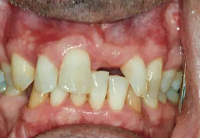 Close-up of teeth showing severe misalignment, crowding, and uneven spacing in upper and lower jaws.