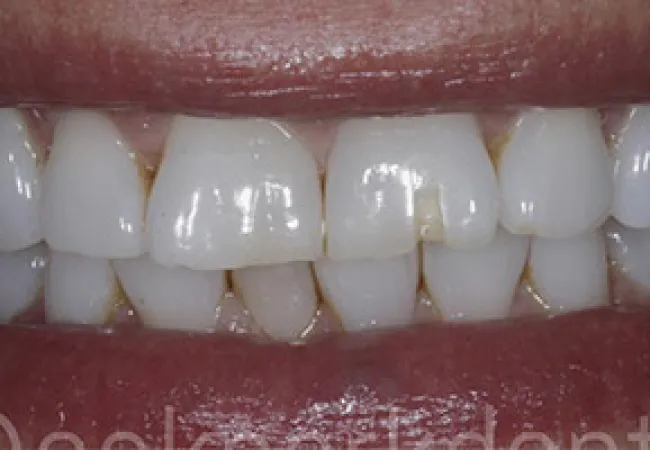Close-up of a smile showing chipped and uneven front teeth with healthy gums and lips.