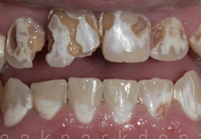 Close-up of teeth with severe brown and white enamel discoloration and decay on upper and lower front teeth.