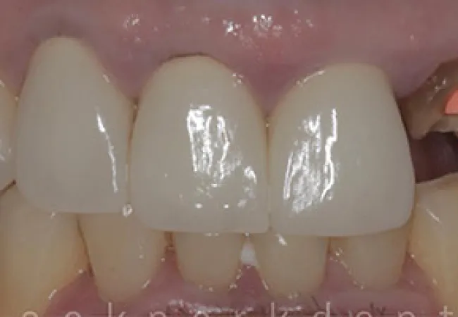 Close-up of upper front teeth showing healthy teeth and a dental implant abutment on the right side.
