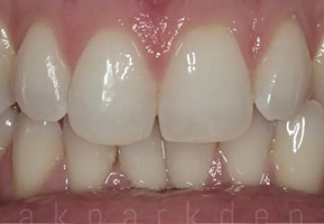 Close-up of healthy white teeth with slight crowding and pink gums in a smiling mouth.