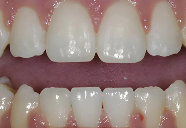 Close-up of human teeth showing a diastema gap between upper front teeth and healthy gums.