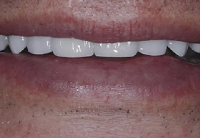 Close-up of a smile showing clean, white upper teeth and natural lips with some facial hair.