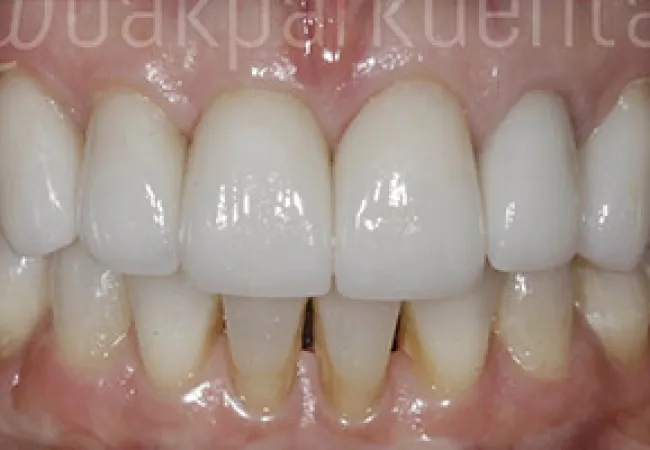Close-up of teeth showing dental veneers on upper front teeth with natural lower teeth and gums visible.