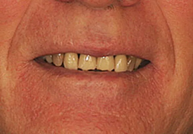 Close-up of an elderly person's mouth showing worn and stained teeth with visible gaps and discoloration.