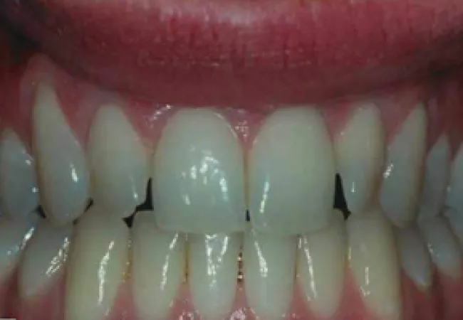 Close-up of natural teeth showing slight spacing and healthy gums in a bright smile.