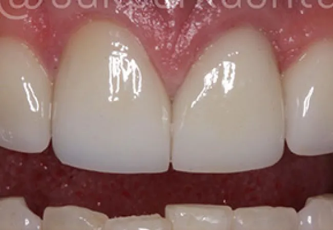 Close-up of upper and lower teeth showing a gap between the upper front teeth with healthy gums.