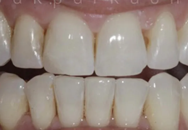 Close-up of upper and lower human teeth showing natural dental alignment and tooth surface details.