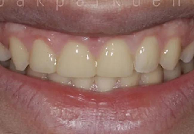 Close-up of a partially smiling mouth showing yellowish teeth with visible gaps and uneven alignment.