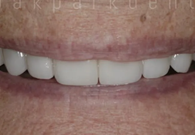 Close-up of a smile showing white, even teeth and part of lips with natural skin texture.