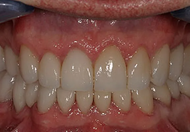 Close-up of teeth showing tight occlusion with natural color and healthy gums under dental examination.
