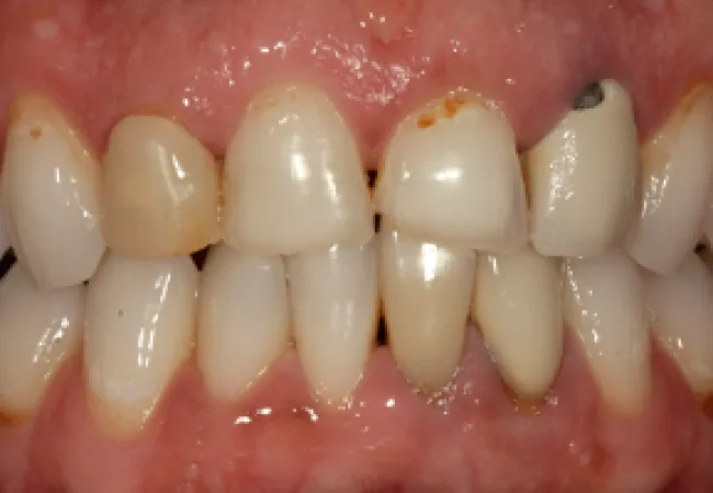 Close-up of human teeth showing discoloration, plaque buildup, and dental decay on upper front teeth.