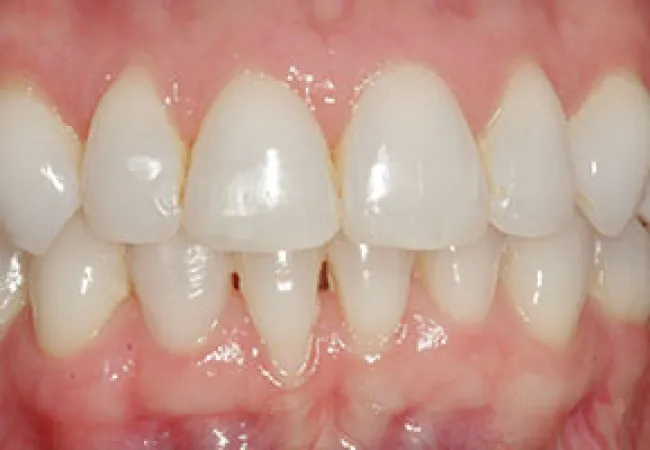 Close-up of healthy, clean human teeth and gums showing dental alignment and natural texture.