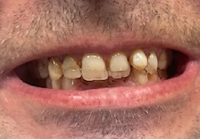 Close-up of a person's mouth showing yellowed, stained, and uneven teeth with visible dental issues.