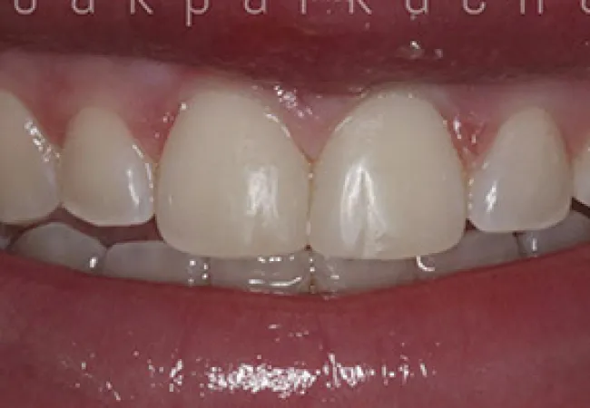 Close-up of human teeth showing slightly gapped and clean upper front teeth and healthy gums.