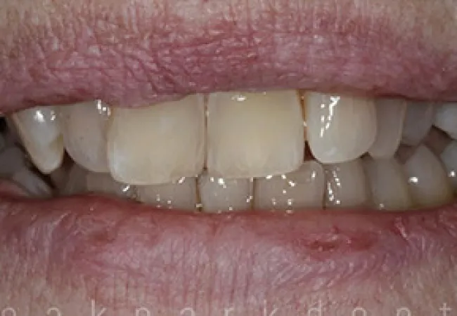 Close-up of a person's mouth showing yellowed, misaligned teeth with chipped edges and dry lips.