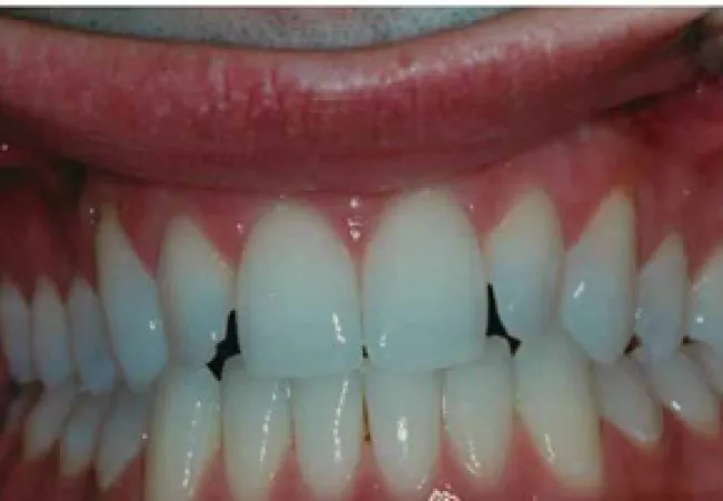 Close-up of an open mouth showing slightly misaligned and chipped upper front teeth and gums