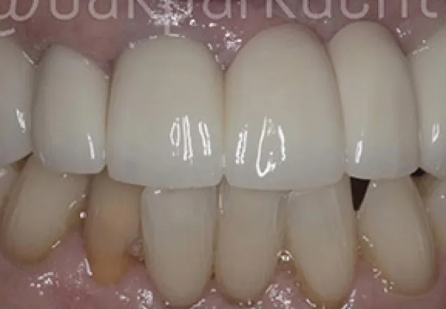 Close-up of dental crowns covering upper front teeth showing a contrast with natural lower teeth.