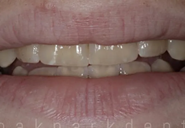 Close-up of slightly parted lips showing stained and misaligned teeth with visible dental plaque.